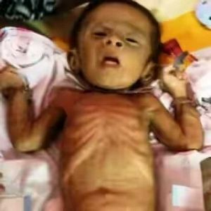 Dialami 21 Anak, Jumlah Kasus Gizi Buruk di Inhil Terbanyak di Riau