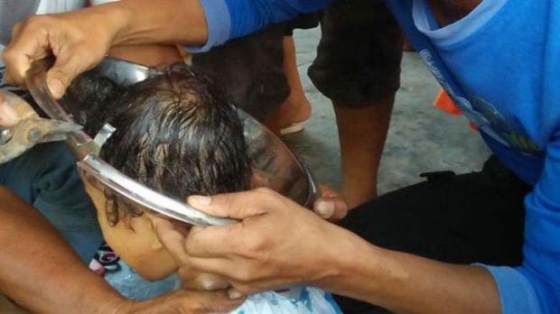 Insiden Menegangkan, Tutup Panci Tersangkut di Kepala Seorang Bocah di Pekanbaru